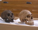 H-floresiensis-Cretin-microcephalic
